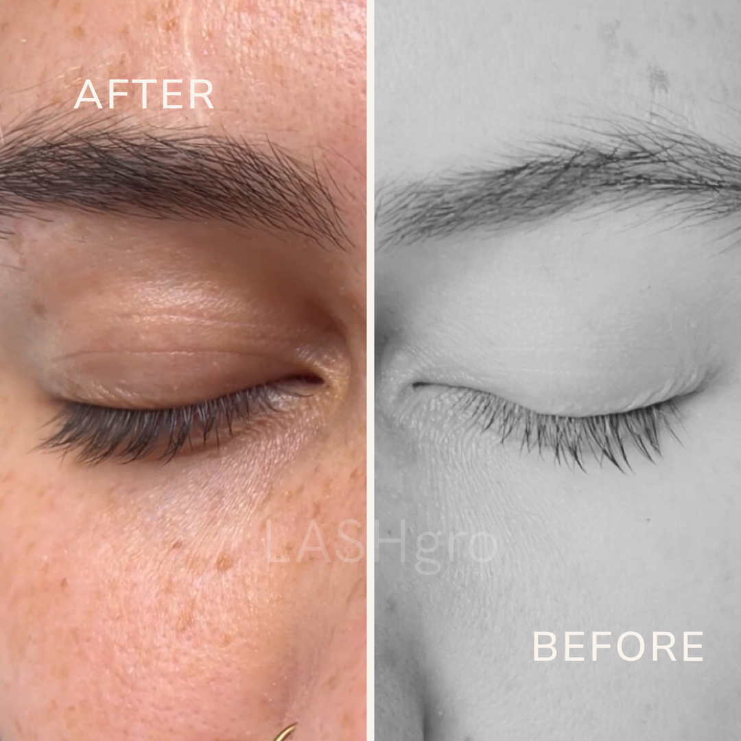 Eyelash Growth with Lashgro